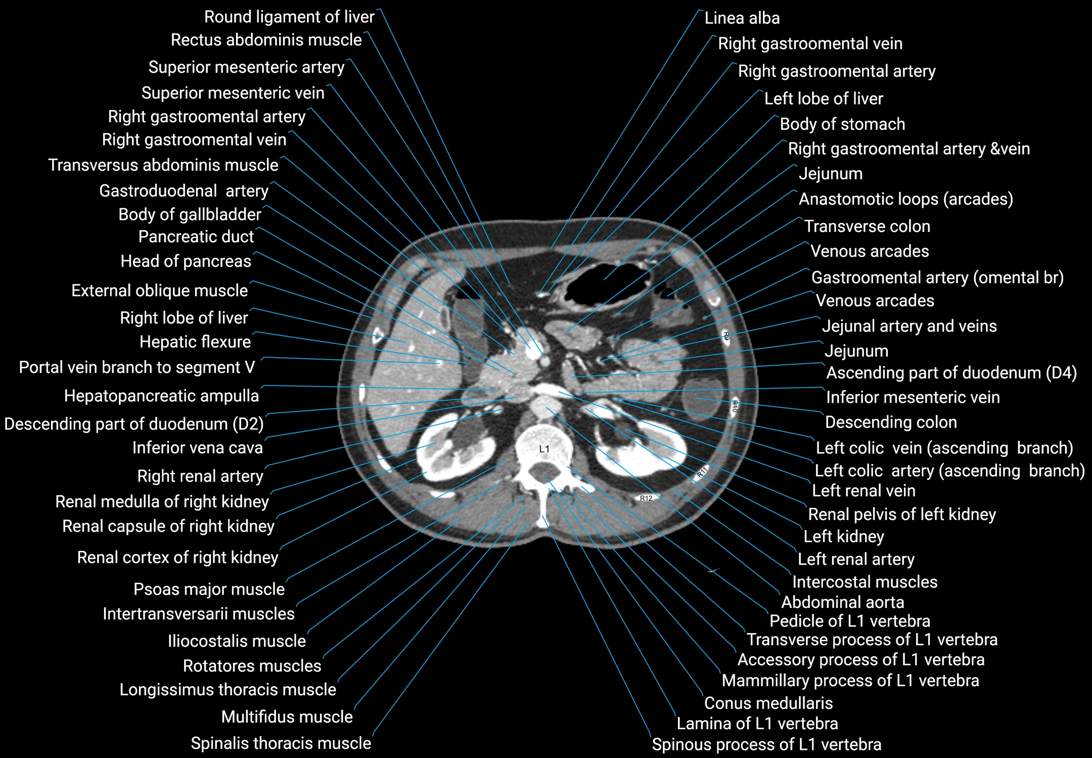 CT male pelvis axial cross sectional anatomy labelled radiology image -00060.webp
